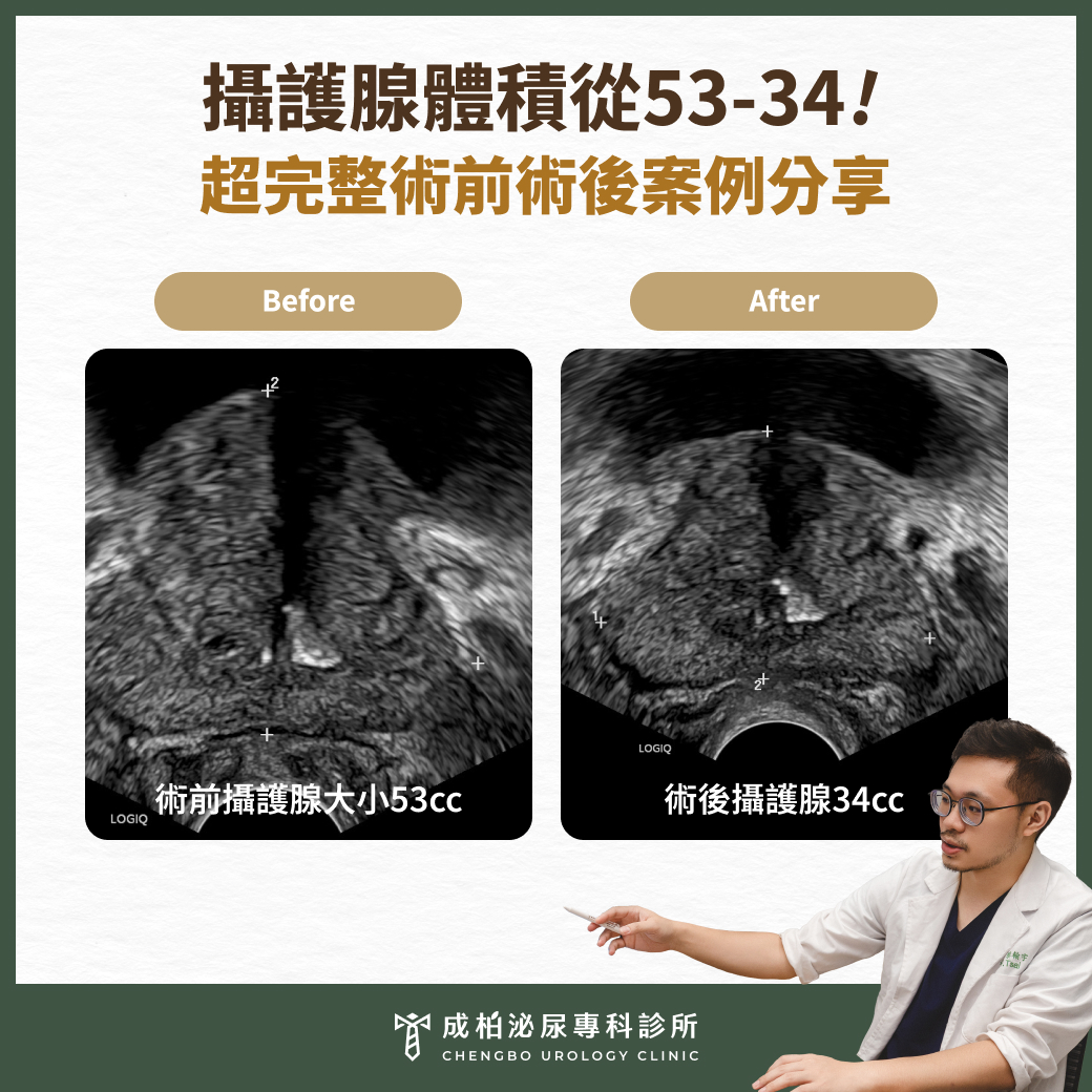 攝護腺體積從53-34！H先生超完整術前術後案例分享