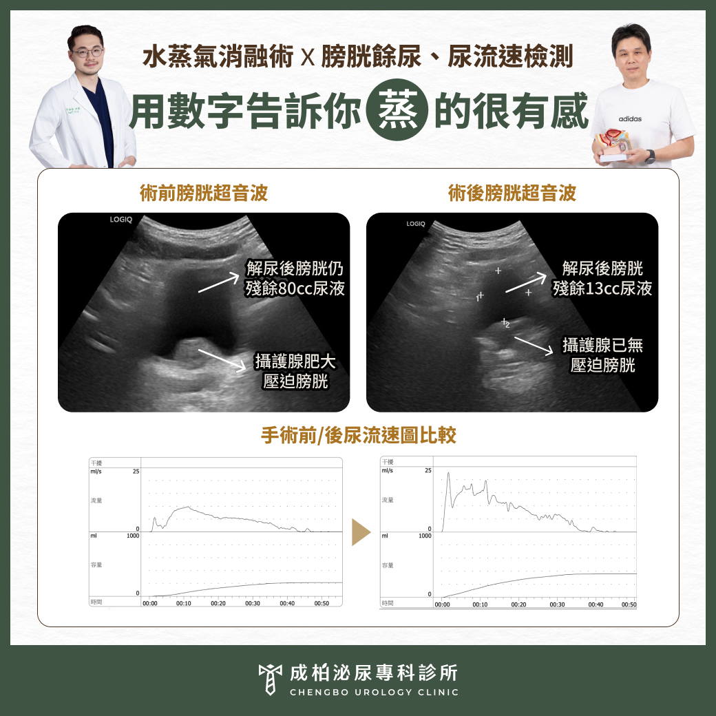 水蒸氣消融術，用數字告訴你蒸的很有感