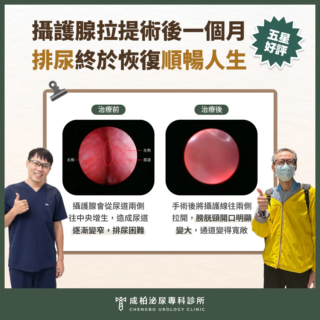攝護腺拉提術後一個月，終於恢復順暢人生