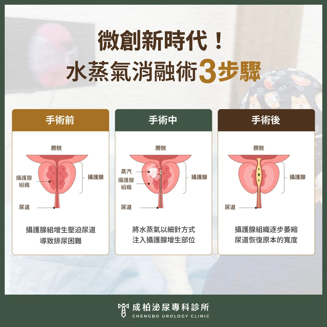 攝護腺水蒸氣消融效果超乎預期!排尿超順暢 1 用時間換取安全性:水蒸氣消融術3步驟