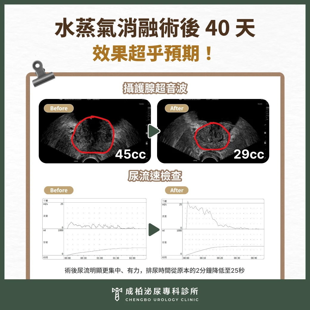 攝護腺水蒸氣消融效果超乎預期!排尿超順暢 2 after2